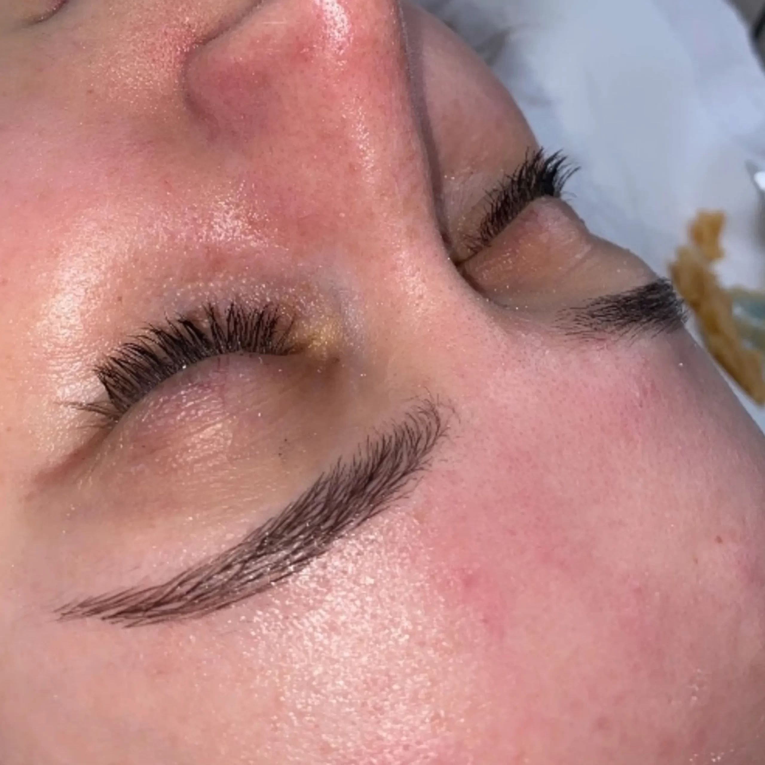 chemical peel vs facial
