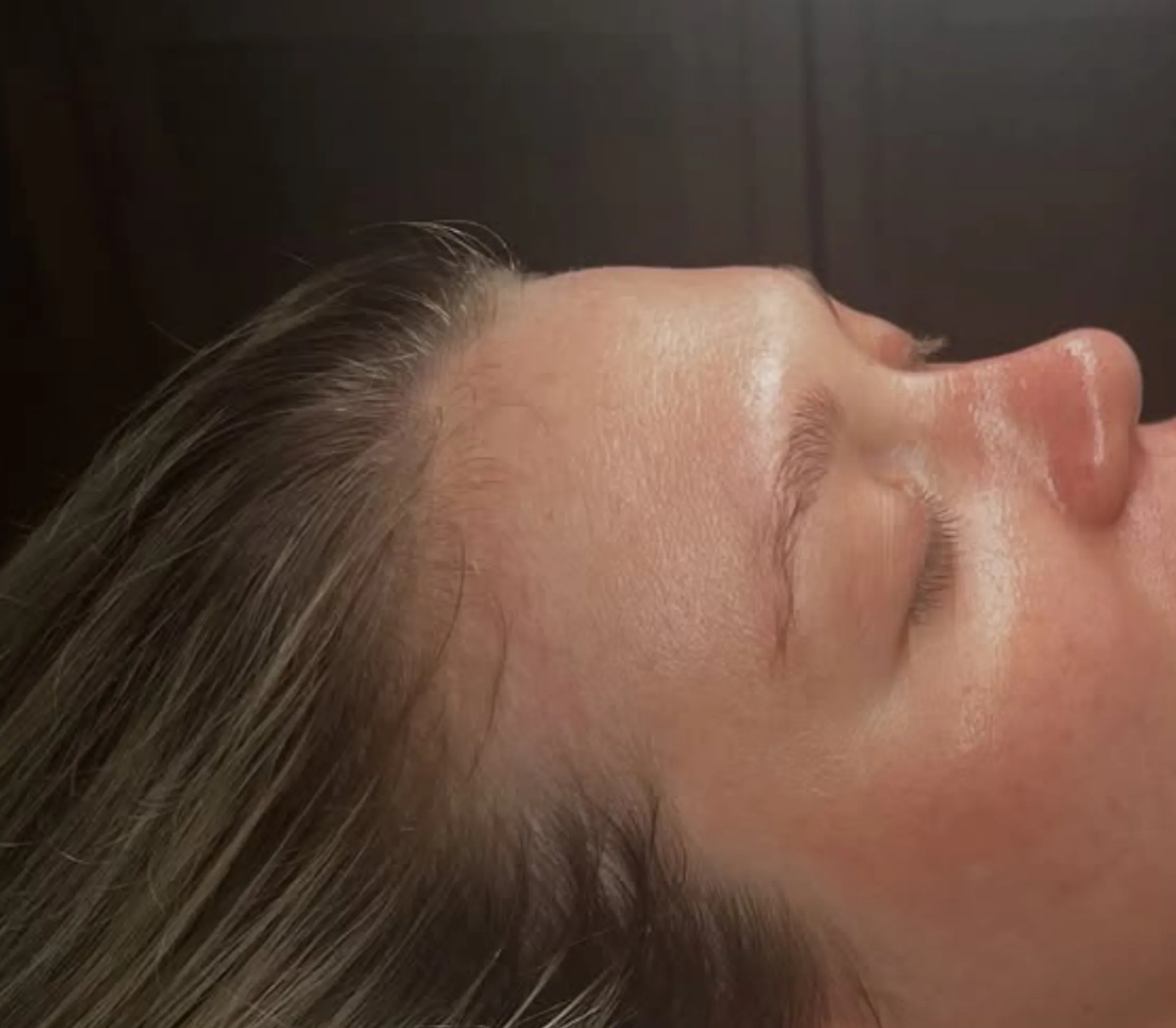 facial for acne-prone skin
