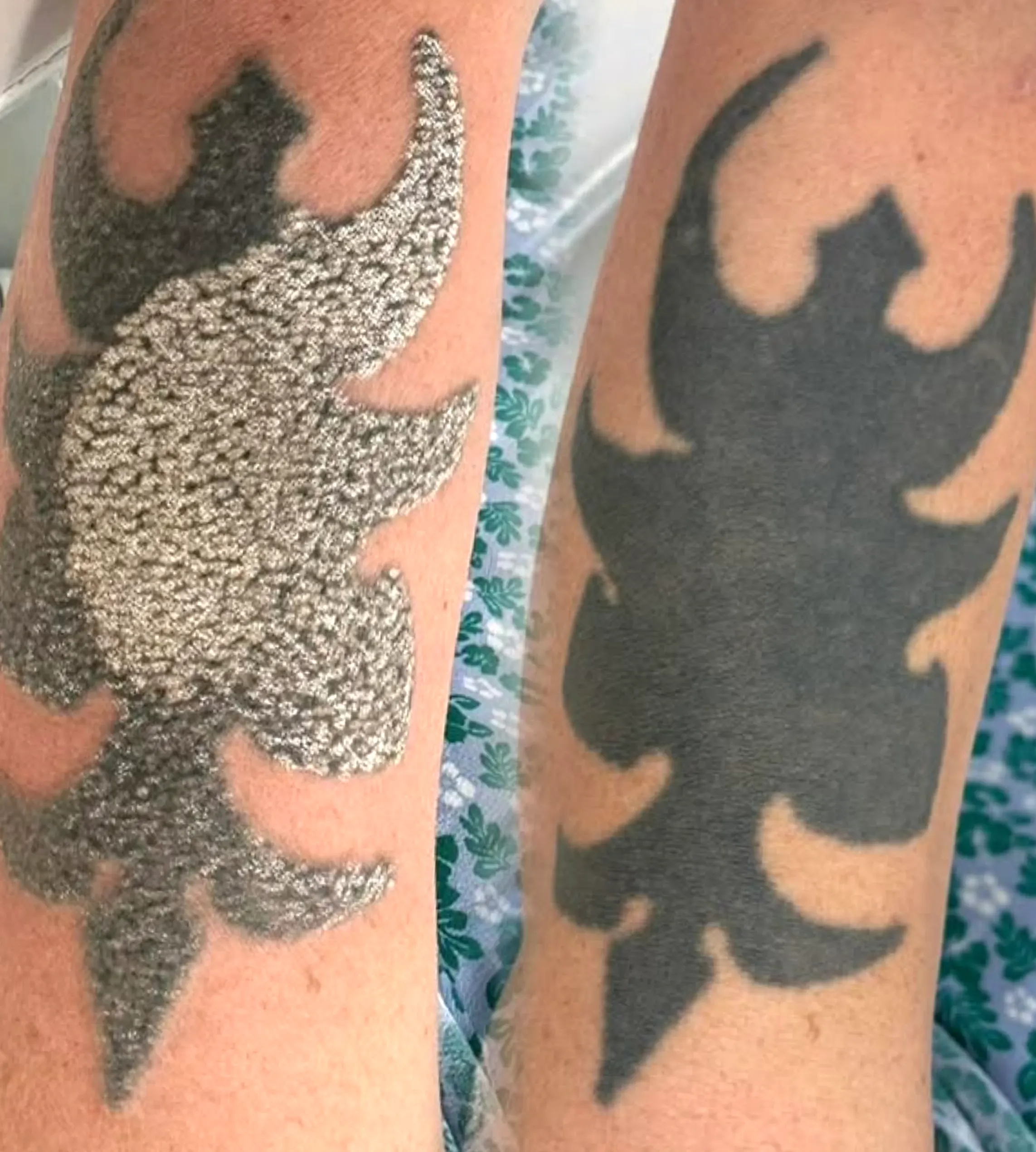 cosmetic tattoo correction insurance