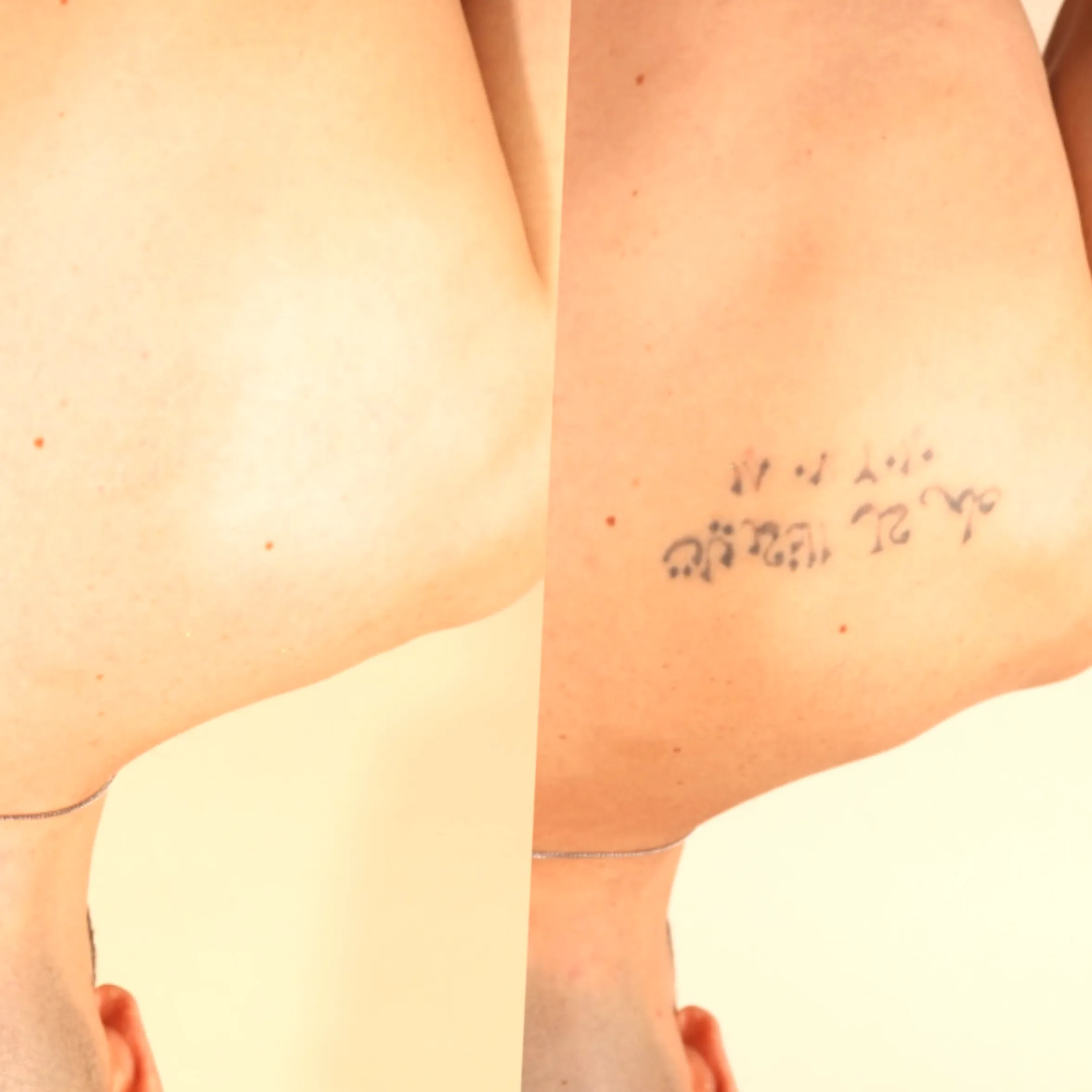 laser tattoo removal insurance