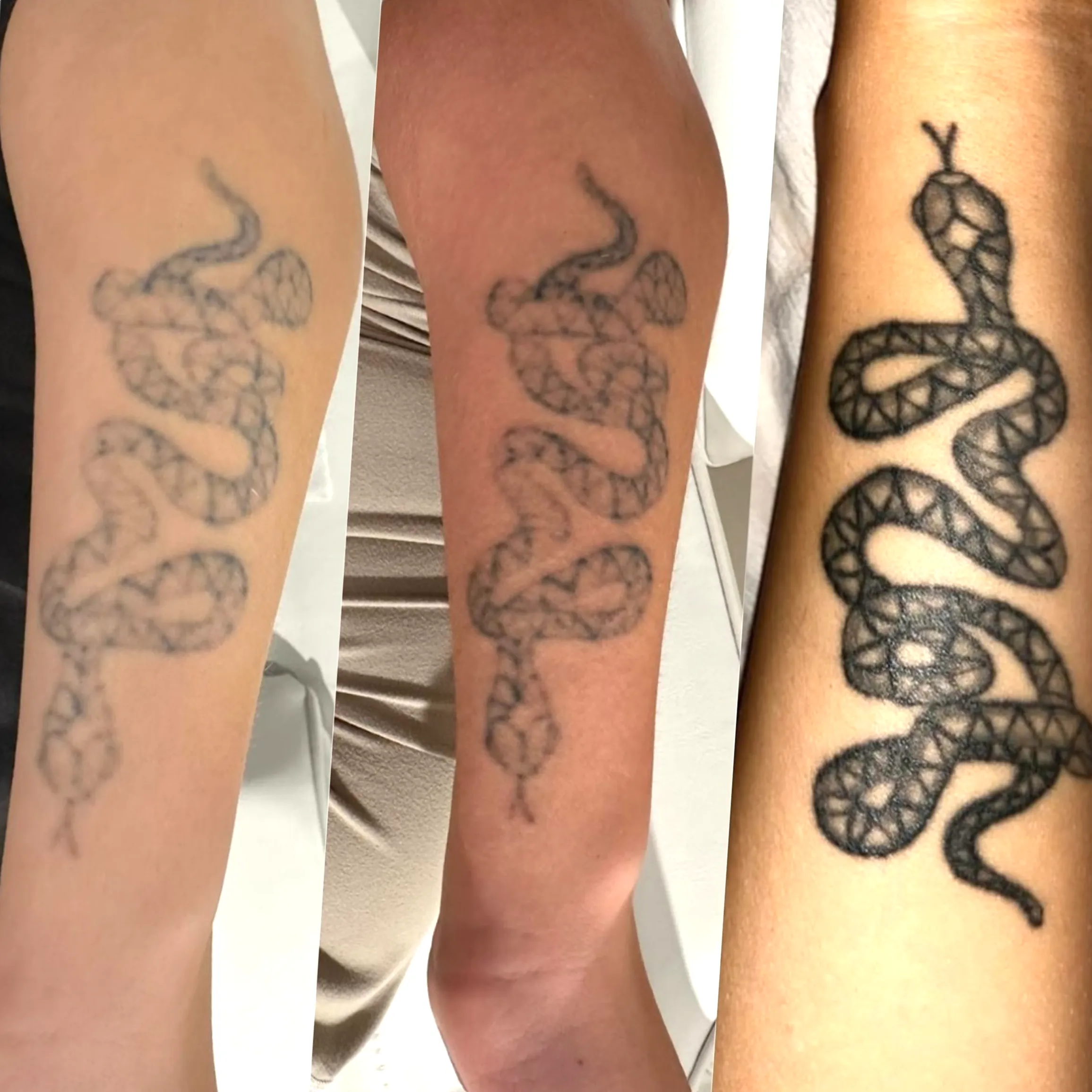professional indemnity tattoo removal