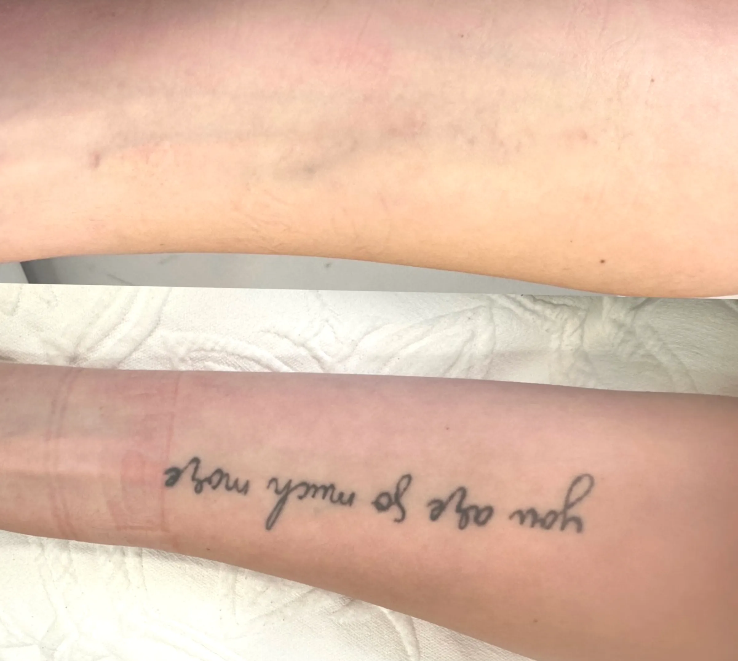 public liability tattoo removal