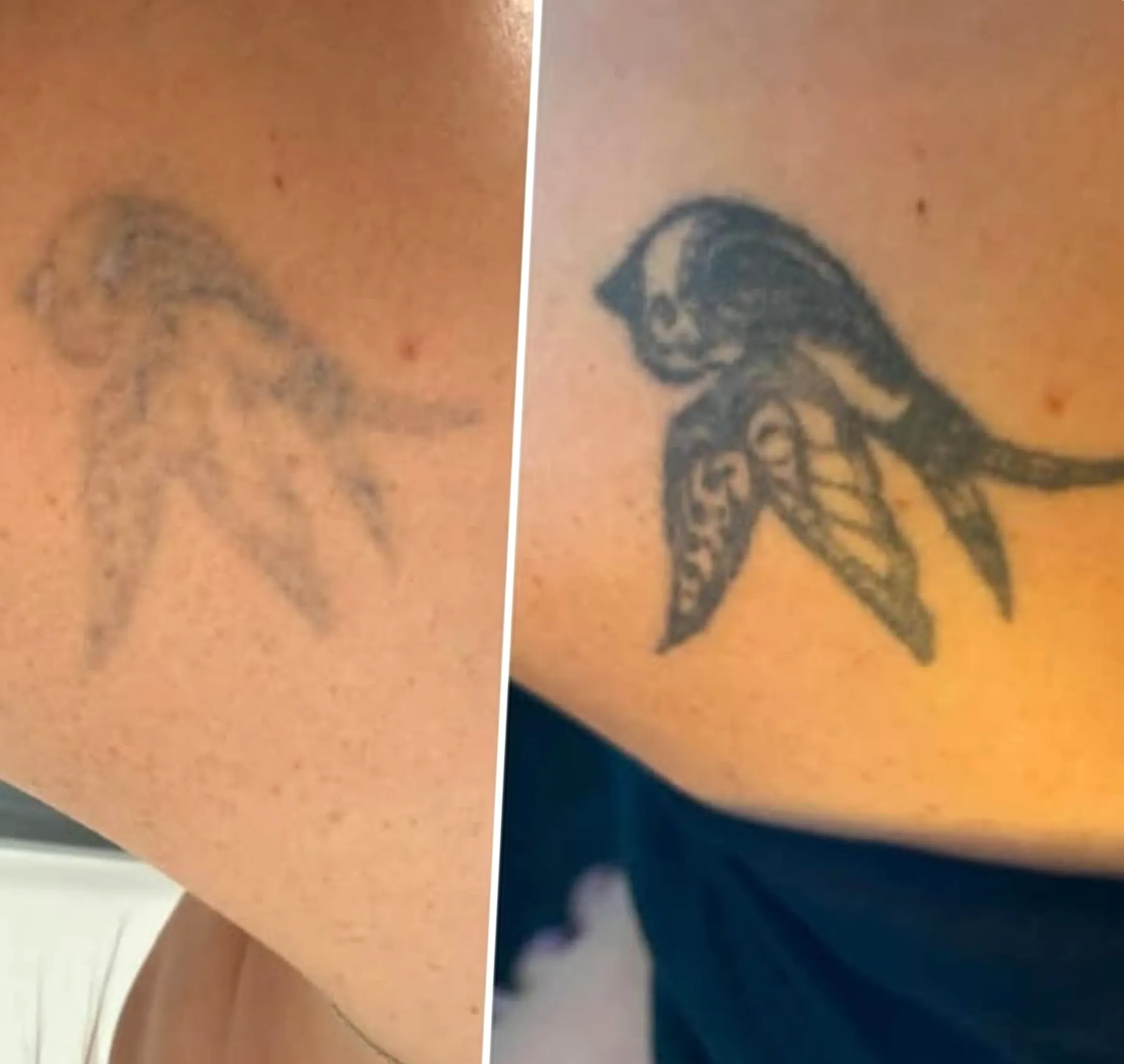 tattoo removal equipment insurance