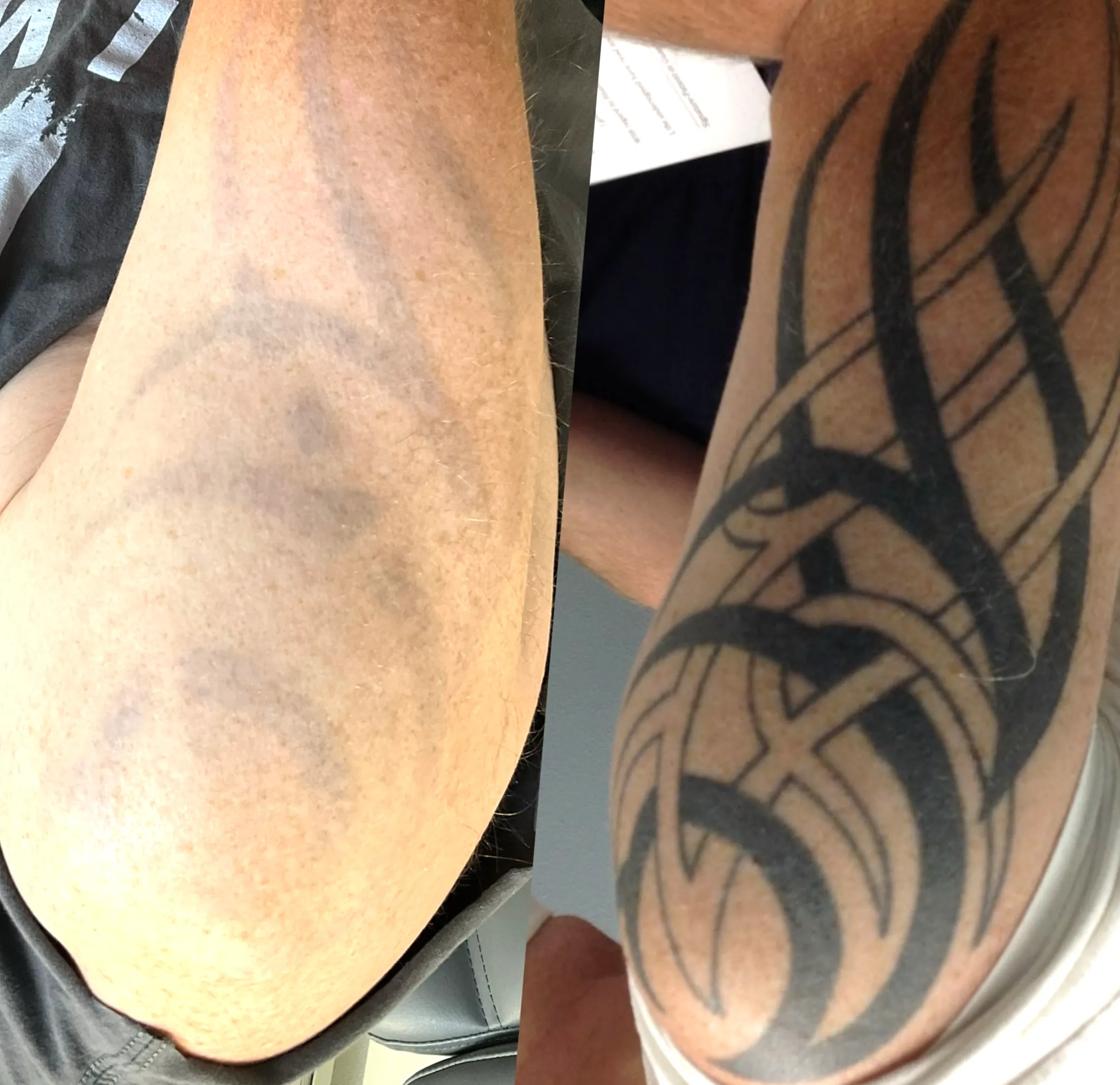 What Insurance Do I Need To Do Tattoo Removal In Australia?