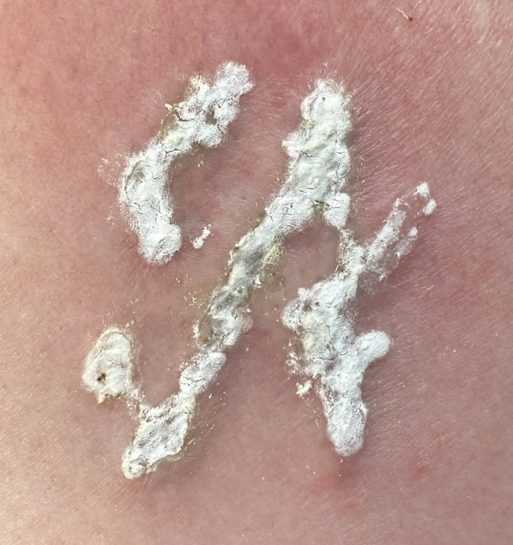 laser tattoo removal course near me