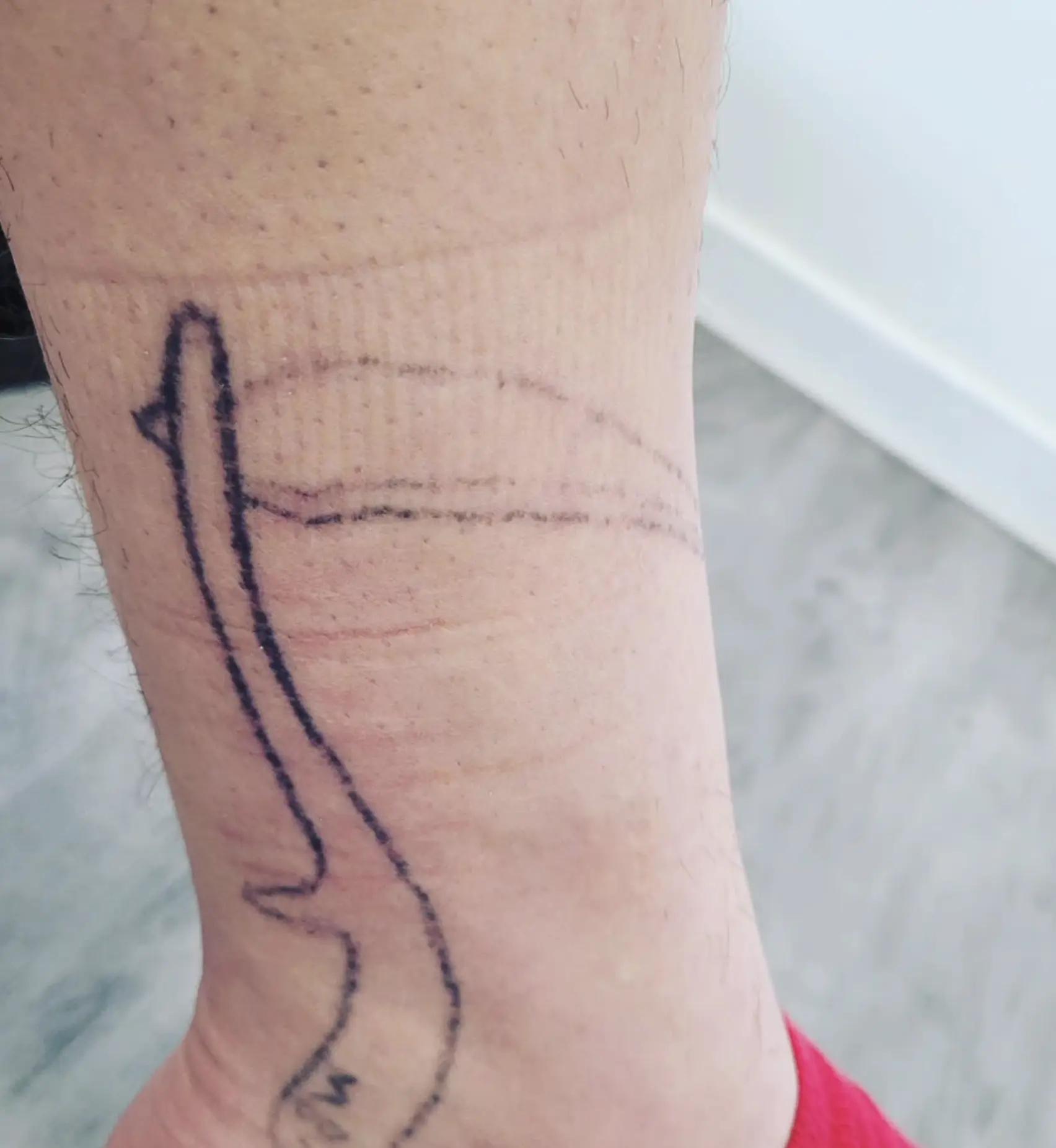 laser tattoo removal course sydney